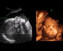 Échographie 4D d'un foetus de 27 semaines 1