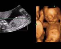 4D Ultrasound a fetus Drinking,Clip no 2