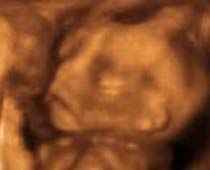 4D Ultrasound a fetus Screaming