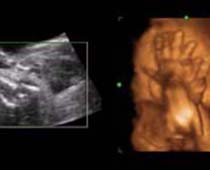 4D Ultrasound a fetus Hiding Face clip 2