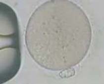 Injection intra cytoplasmique de sperme (ICSI) 2