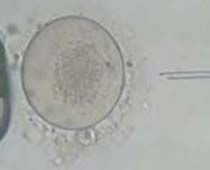 Injection intra cytoplasmique de sperme (ICSI) 1