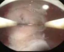 لقطة فيديو لإزالة حاجز في الرحم بواسطة المنظار الرحمي1