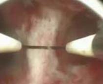 لقطة فيديو لإزالة حاجز في الرحم بواسطة المنظار الرحمي6
