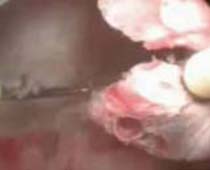 Vidéo résection hystéroscopique de la cloison utérine, coupent pas 5