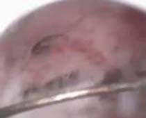 فيديو إزالة التصاقات داخل تجويف الرحم بواسطة المنظار الرحمي2