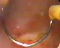 لقطة فيديو لعملية إزالة بطاقة الرحم بواسطة المنظار الرحمي