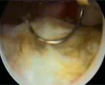 Vidéo hystéroscopie intra-utérine adhérences résection (Synaechiae) CLIP no 1