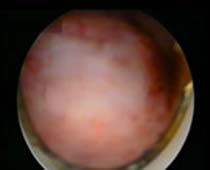 Retrait de la vidéo de fibrome utilisant l'hystéroscope (hystéroscopie myomectomie)