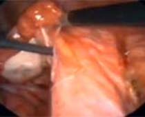 Clip Vidéo opération laparoscopique Adhésiolyse où adhérences pelviennes sont disséqués n ° 2
