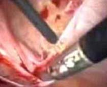 Vidéo laparoscopique Adhésiolyse où adhérences pelviennes sont disséqués suivie par salpingectomie