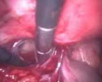 Clip vidéo laparoscopique Adhésiolyse où adhérences pelviennes abdominales sont disséqués n ° 7