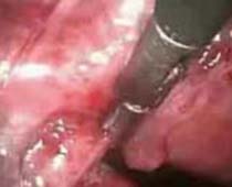 Vidéo opération laparoscopique Adhésiolyse où adhérences intra-abdominales sont disséqués, coupent pas 1