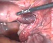 Vidéo de la suppression de la grossesse extra-utérine (en dehors de l'utérus) par laparoscopie. couper n ° 3