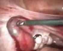 Video of removing of Ectopic Pregnancy (in fallopian tube) by Laparoscopy. clip no 1