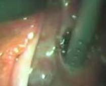 Vidéo de la suppression de la grossesse extra-utérine (en dehors de l'utérus) par laparoscopie. couper n ° 2