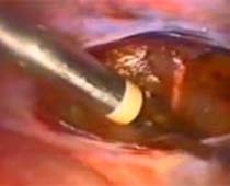 Retrait de la vidéo de l'utérus à l'aide du laparoscope (hystérectomie laparoscopique)