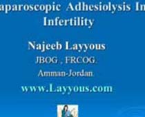 Laparoscopique Adhésiolyse Dans infertilité