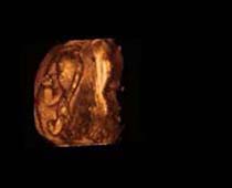 3D Ultrasound of Fifteen Weeks Fetus