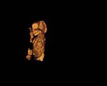 Échographie 3D de Premier Trimestre foetus 9