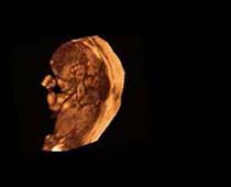 Échographie 3D de quatorze semaines Foetus 2