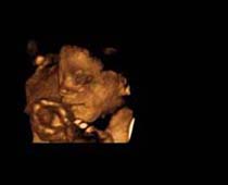 3D Ultrasound of Fetal Face clip 7
