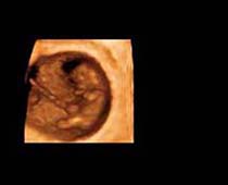 Échographie 3D de Premier Trimestre foetus 7