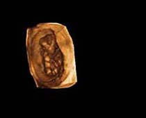 Échographie 3D de onze semaines foetus