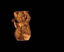 3D Ultrasound of Sixteen Weeks Fetus
