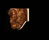 Échographie 3D de Premier Trimestre foetus 5