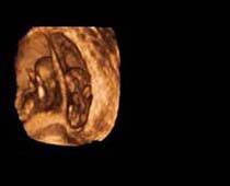 3D Ultrasound of 10 Weeks old Twins