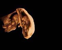 التراساوند ثلاثي الابعاد لجنين في الثلث الثاني من الحمل