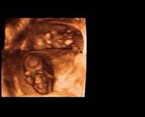 3D Ultrasound of 10 Weeks old Fetus clip no 3
