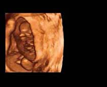 3D Ultrasound of 10 Weeks old Twins 4