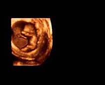 3D Ultrasound of 10 Weeks old Fetus clip no 1