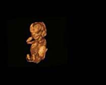 Échographie 3D de Second Trimestre foetus 7