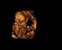 Échographie 3D de Second Trimestre foetus 10