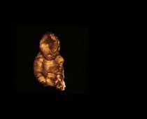 Échographie 3D de Second Trimestre foetus 2