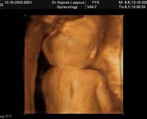 Diaporama de 3D ultrason photos des parties du fœtus