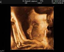 Diaporama de 3D échographie des profils fœtales