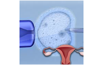 Intra Uterine Insemination, Success Rates - Risks - Uses - IUI