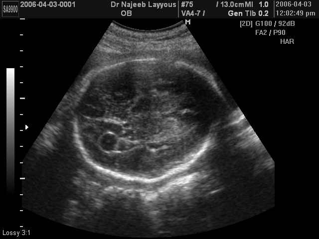 Choroid plexus cyst