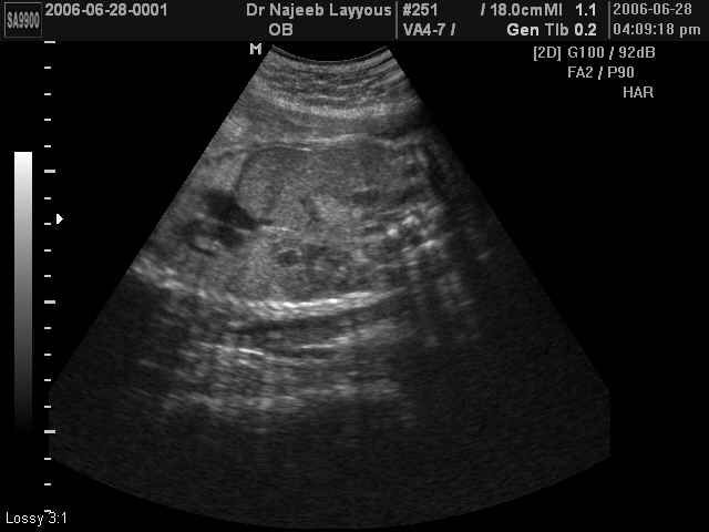 Severe Oligohydramnios