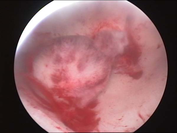 polype endometrial