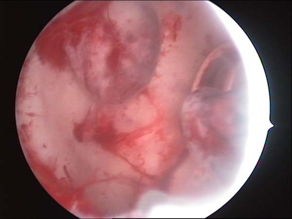 polype endometrial