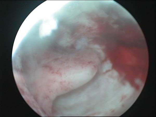 polype endometrial