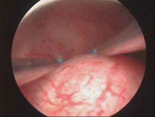 hysteroscopic myomectomy