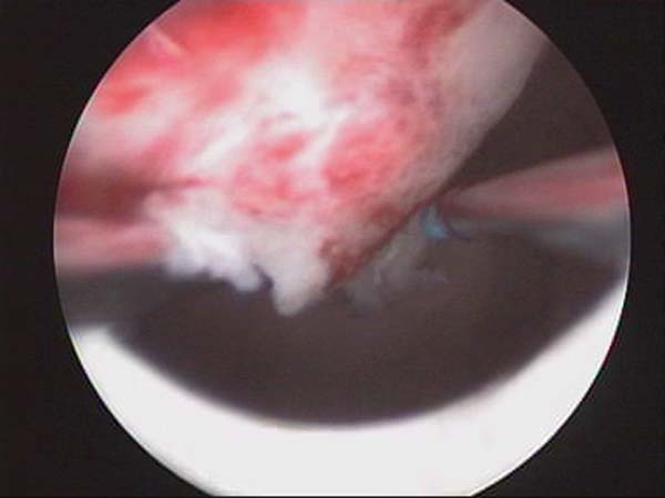 hysteroscopic myomectomy