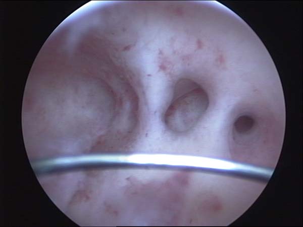 إزالة التصاقات داخل تجويف الرحم بواسطة المنظار الرحمي