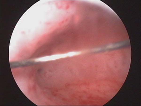 opening of fallopian tube